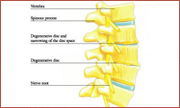 Bone Spur