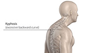 degenerative disc