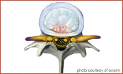 spinal stenosis