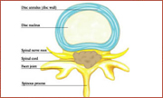 spinal tumor