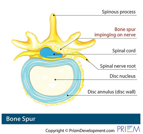 bone spur