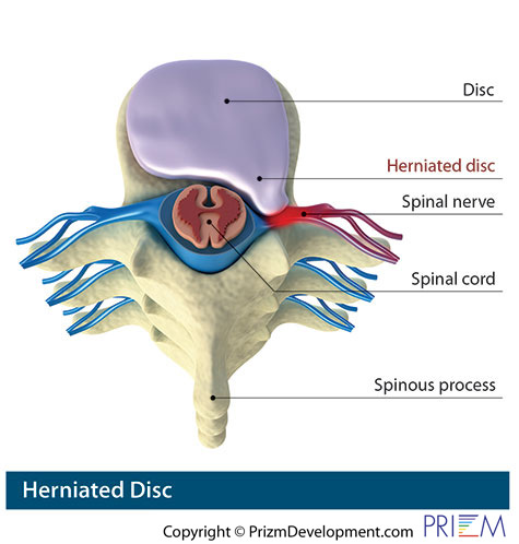 herniated