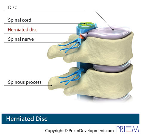 herniated disc