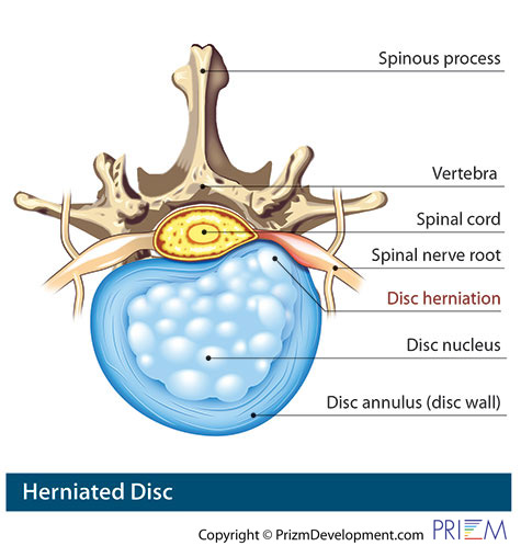 herniated disc treatment