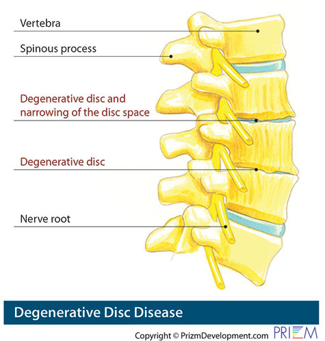 degenerative disc king of prussia