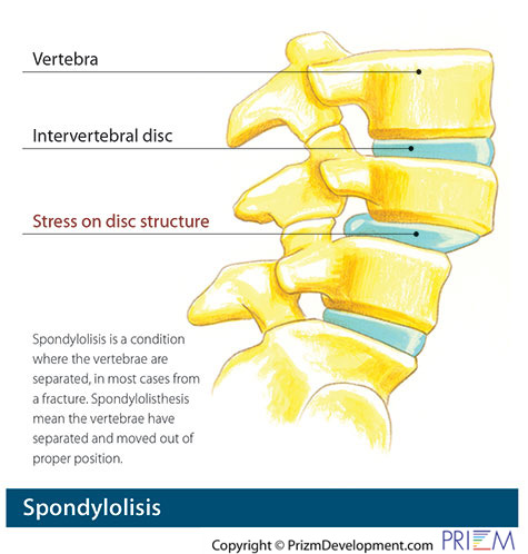 spondylolysis