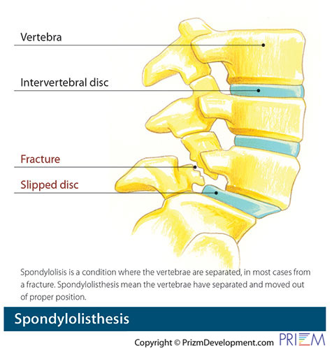 spondylolisthesis